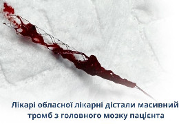 У Чернівцях медики обласної лікарні зробили неймовірне: дістали масивний тромб із головного мозку пацієнта